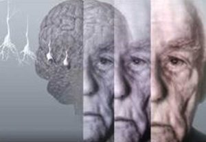 بیماری آلزایمر